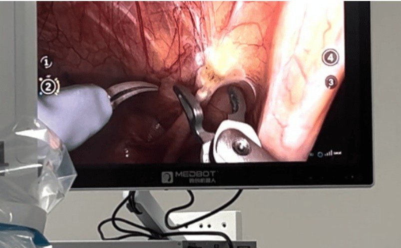 Robotic Tele-Surgery Connects China and Brazil in Landmark Medical Procedure
